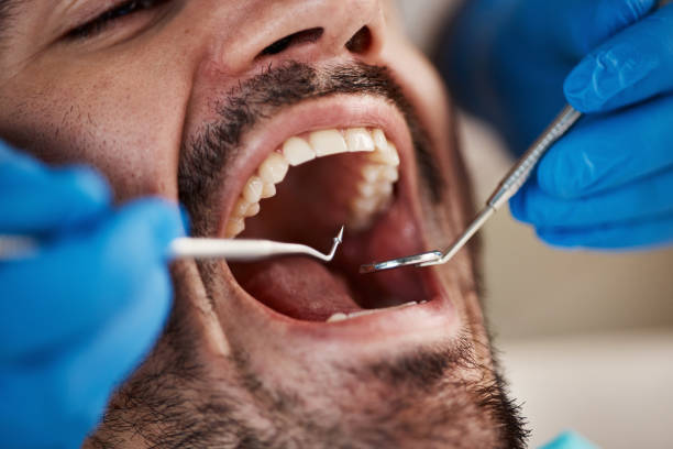 Best Emergency Dental Care for Broken or Chipped Teeth in Collinsville, CT